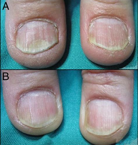 Treatment For Psoriatic Nails