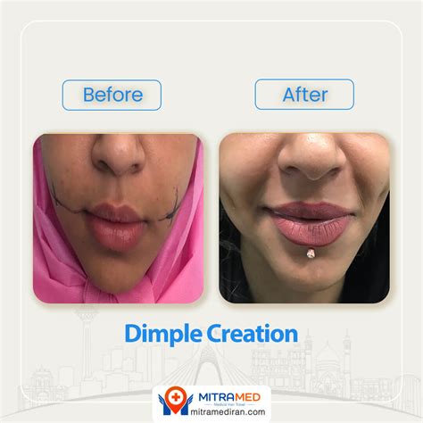 Dimple Surgery in Iran | Dimpleplasty | Dimple Creation | MITRAMED