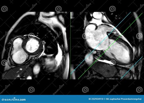MRI Heart Or Cardiac MRI Royalty-Free Stock Image | CartoonDealer.com #252924910