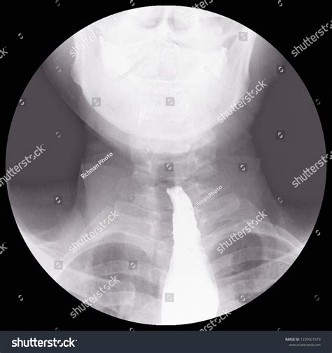 Barium Swallow Xray Evidence Achalasia Distal Foto stock 1239501979 | Shutterstock