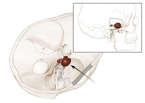 Meckel’s Cave (cavum trigeminale), also known as the trigeminal cave, is a cavity between two ...