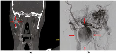 Arteriovenous Fistula with Pseudoaneurysm and Facial Palsy Following ...