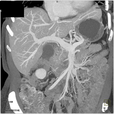 Pancreas Adenocarcinoma with Dilated Pancreatic Duct - Pancreas Radiology Case Studies - CTisus ...