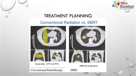 SBRT (Stereotactic Body Radiation Therapy in Lung Cancer.pptx