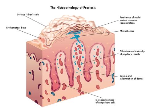 Dermatology Associates | Psoriasis