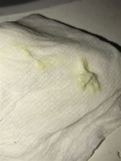 Mucus plug or discharge? | BabyCenter