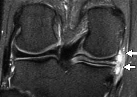 Association of Parameniscal Cysts With Underlying Meniscal Tears as Identified on MRI and ...