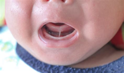 Swollen Gland In Mouth Under Tongue - Infoupdate.org