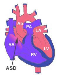 ASD - Atrial septal defekt