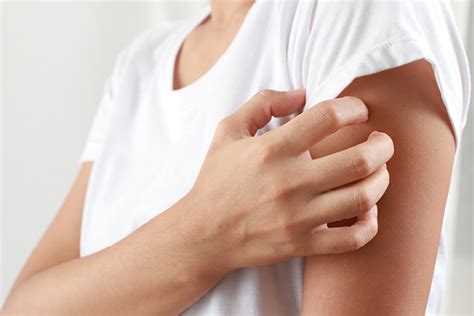 Everything You Need To Know About Hives