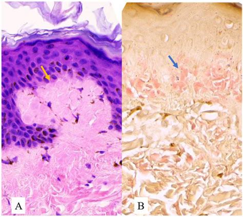 Amyloidosis Cutis Dyschromica in a 16-Year-Old Filipino Girl: A Case Report