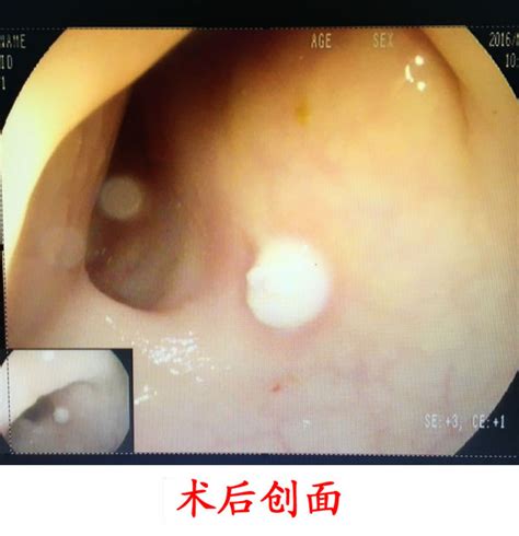 好消息!我院胃镜室成功实施结肠息肉内镜下高频电切术一例 - 滨州市中医医院