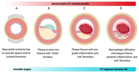 C Reactive Protein High C Reactive Protein Level As Diagnostic Marker