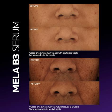 La Roche-Posay Mela B3 Serum, Dark Spot Corrector Australia | Ubuy