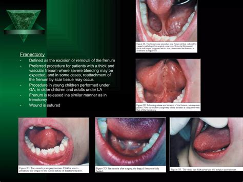 Ankyloglossia (Tongue-tie) | PPT