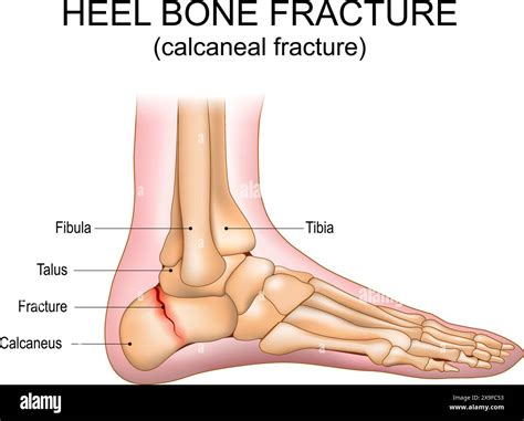 Shattered Talus Bone