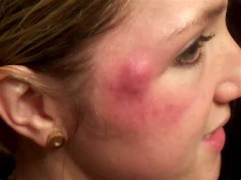 Image result for Exploding Zit Videos 2013