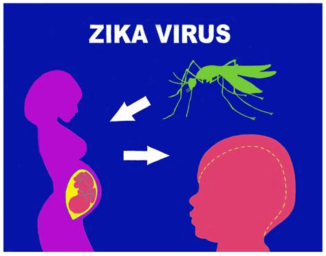 Congenital Zika Virus Syndrome: Microcephaly and Orofacial Anomalies
