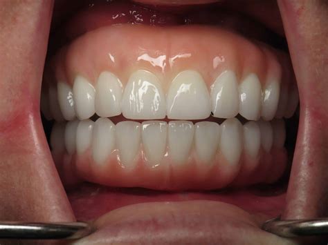 Dental Code For Zirconia Implant at Harry Brawner blog
