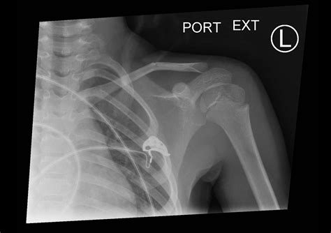 Clavicle Fracture Newborn Xray