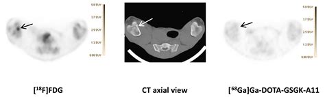 Attempts to Target Staphylococcus aureus Induced Osteomyelitis Bone ...