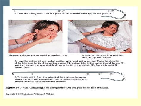 Nasogastric tube insertion | PPT