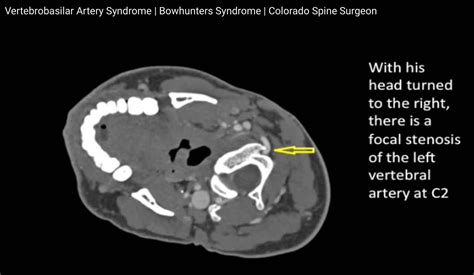Vertebrobasilar Artery Syndrome
