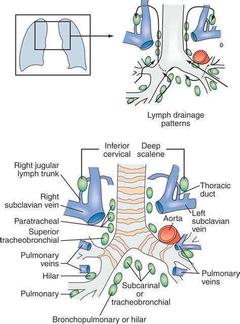 Mediastinal and Hilar Lymphadenopathy - Clinical Tree