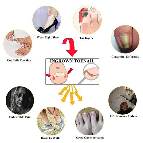 Ingrown Toenail Treatment Kit - Stainless Steel Corrector for Curved Toenails | Includes 12 ...