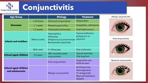 Conjunctivitis Nhs Guidelines | Conjunctivitis Viral – WHKRQ