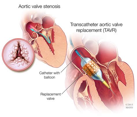 Mayo Clinic Q and A: Mild to Moderate Aortic Stenosis Typically Doesn't Require Surgery - Mayo ...
