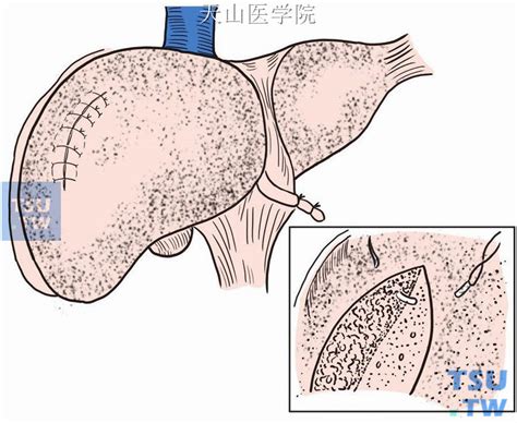 【图】肝部分切除术 - 外科手术学 - 天山医学院