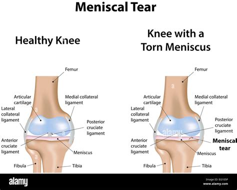 Knee meniscal tear hi-res stock photography and images - Alamy