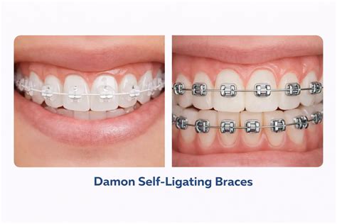 Self Ligating Braces : Why Should You Choose Them