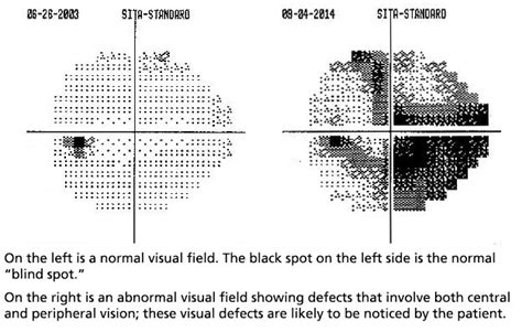 Image result for Field Vision Testing Procedure