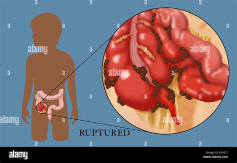 Image result for Perforated Appendix