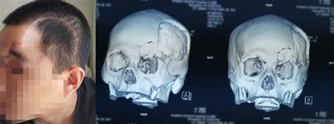 甘肃省第三人民医院神经外科为严重颅骨粉碎性凹陷性骨折合并局部脑挫伤患者行开颅一期整复手术成功 - 脑医汇 - 神外资讯 - 神介资讯