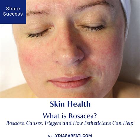 How Often Should You Wash Your Face If You Have Rosacea at Emerita Yamamoto blog