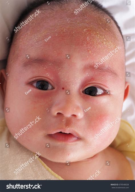 Seborrheic Dermatitis Infant