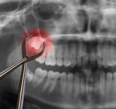 Extracted Wisdom Tooth 的图像结果