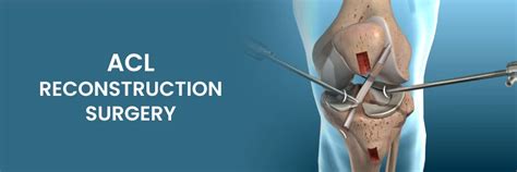 ACL Reconstruction Surgery: Symptoms, Procedures, and More