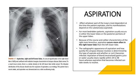 Here Are Lungs Aspirated Without Risk: A Patient Guide