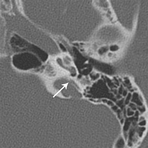 Semicircular canal dehiscence - Operative Techniques in Otolaryngology-Head and Neck Surgery