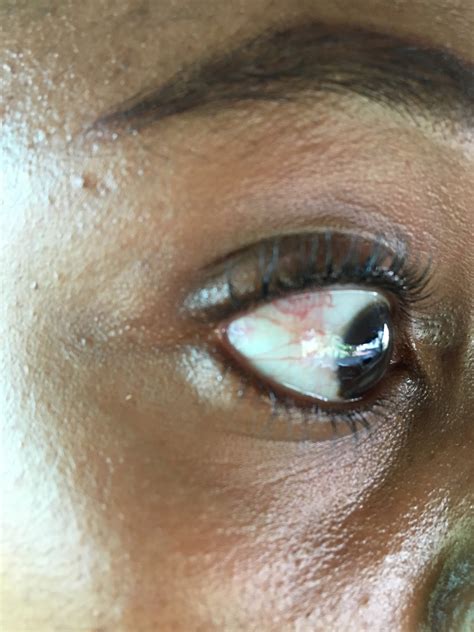 How to get rid of a brown spot / discolouration on the whites of the eye / sclera - black spot white of eye