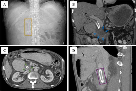 CT imaging features of bile duct stent complications - Clinical Imaging