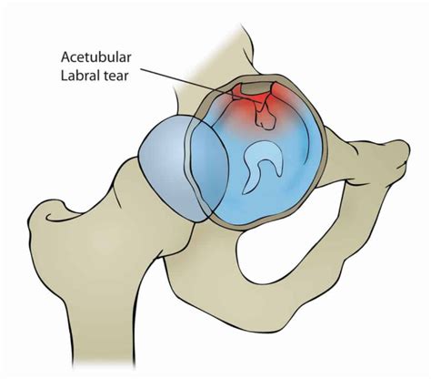 Hip (acetabular) labral tear: हिप (एसेटाबुलर) लेब्रल टीयर क्या है ...