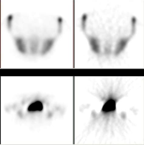 Image result for Iterative Reconstruction Osem