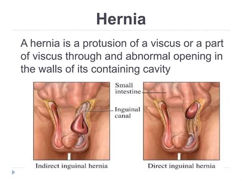 Inguinal and Femoral hernia | PPTX