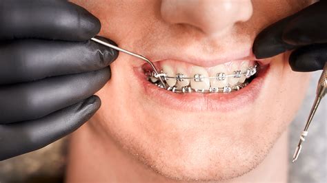 Remove Brackets 的图像结果