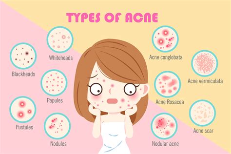 Chin Acne : How do you get rid of it